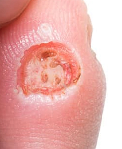 Moisture-Associated Skin Damage (MASD)